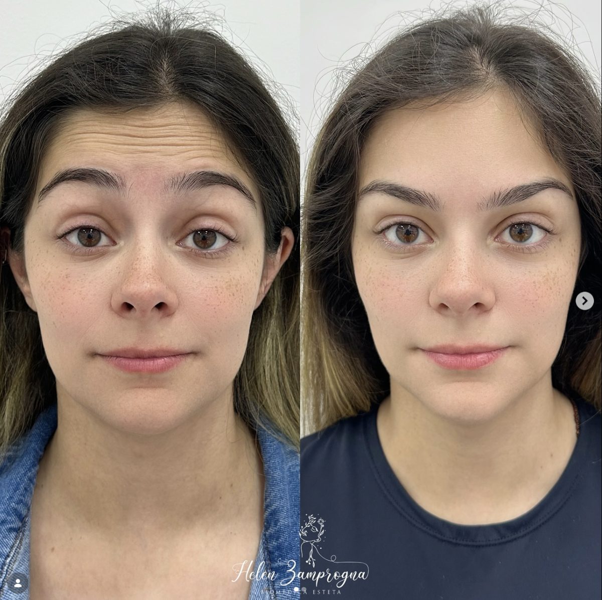 Botox na testa: antes (à esquerda) e depois (à direita)