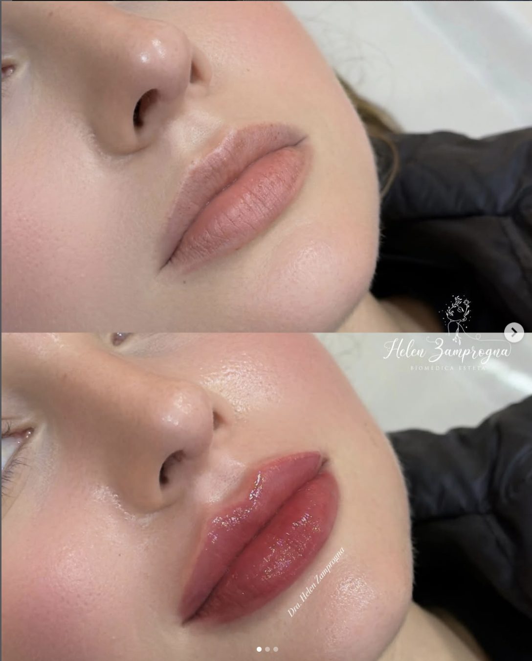 Preenchimento labial: antes (em cima) e depois (embaixo)
